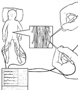 تجربتي مع عملية SDR لعلاج الشلل الدماغي