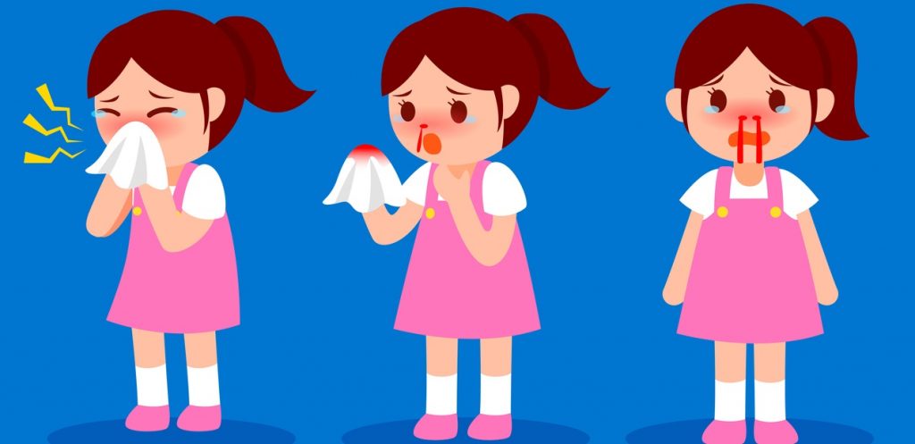 الرعاف أو نزيف الأنف عند الأطفال، أسبابه وطرق منزلية لعلاجه